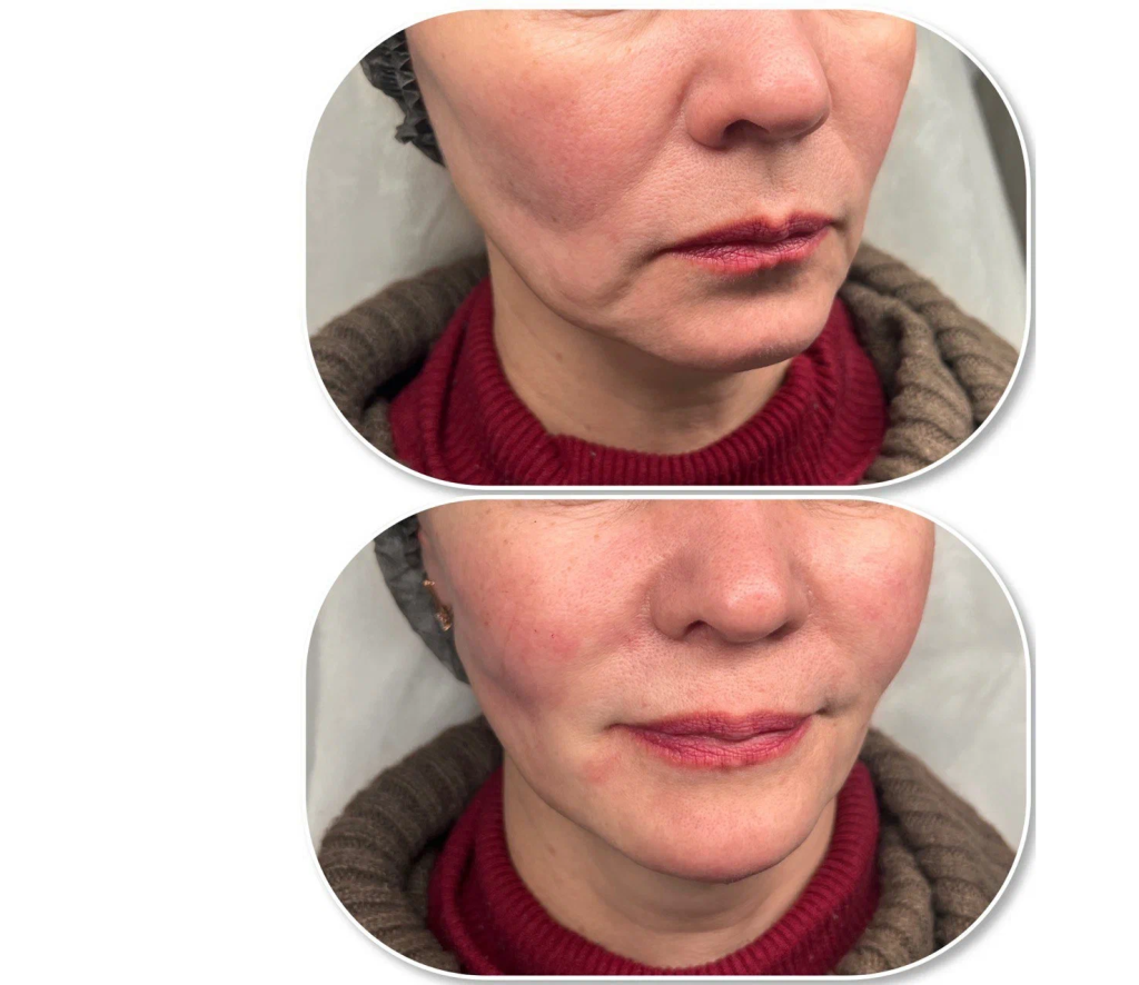 Результат применения #1