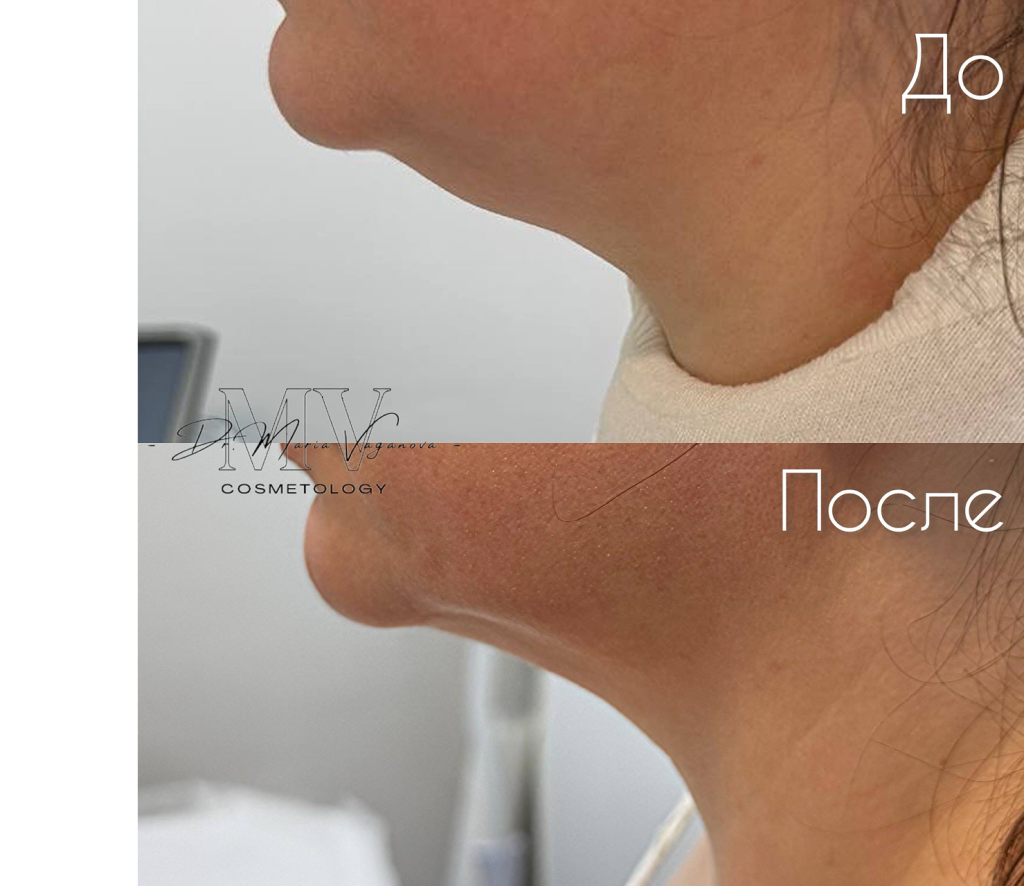 Результат применения #1