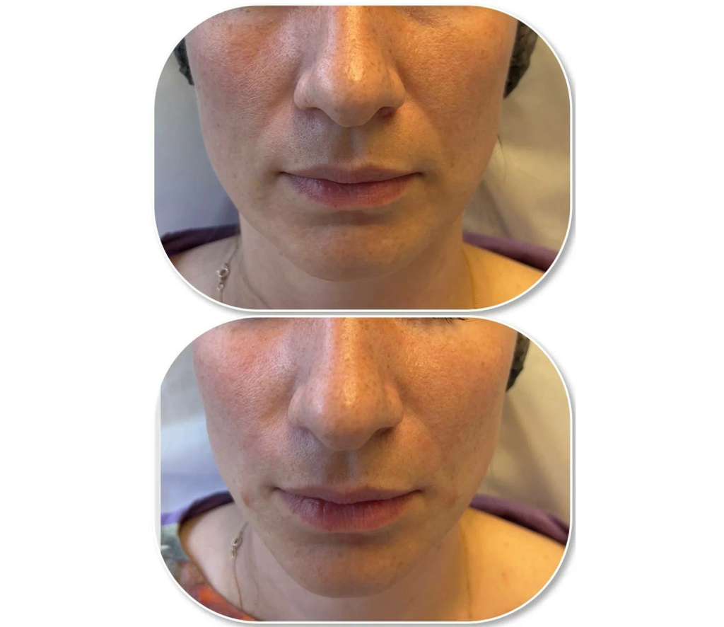 Результат применения #1